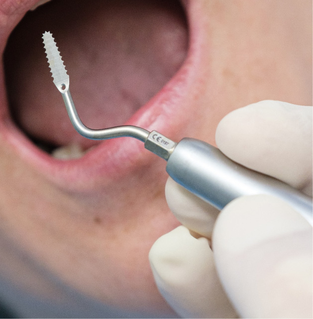 Piezosurgegery | Studio Dentistico Banzi a Pieve di Cento (BO)