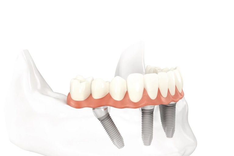 Blog 4 Impianto dentale senza o con poco osso