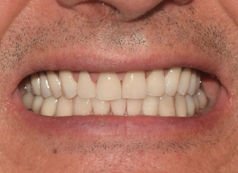 Casi clinici 88 RIABILITAZIONE CORONE SU DENTI NATURALI - dopo 1