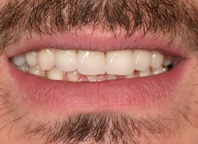 Casi clinici 106 RIABILITAZIONE CORONE SU DENTI NATURALI - dopo 10