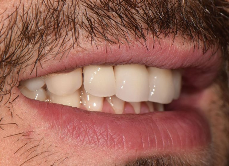 Casi clinici 108 RIABILITAZIONE CORONE SU DENTI NATURALI - dopo 11