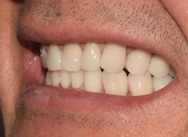 Casi clinici 86 RIABILITAZIONE CORONE SU DENTI NATURALI - dopo 3