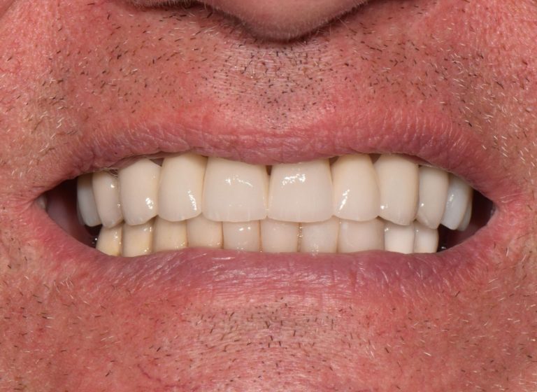 Casi clinici 94 RIABILITAZIONE CORONE SU DENTI NATURALI - dopo 4