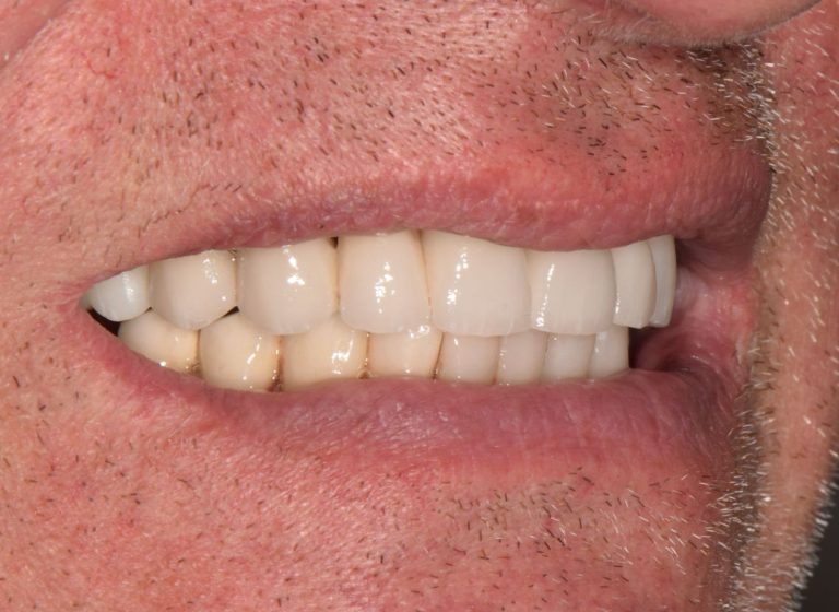 Casi clinici 96 RIABILITAZIONE CORONE SU DENTI NATURALI - dopo 5