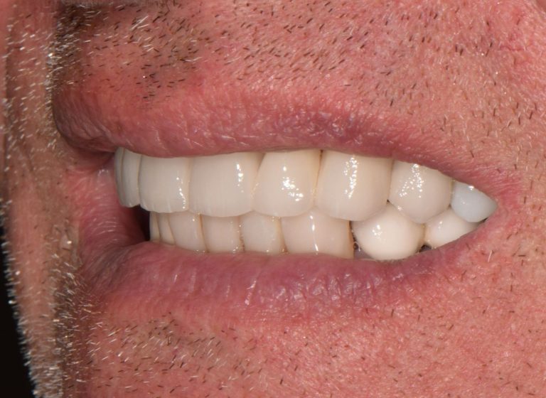 Casi clinici 92 RIABILITAZIONE CORONE SU DENTI NATURALI - dopo 6
