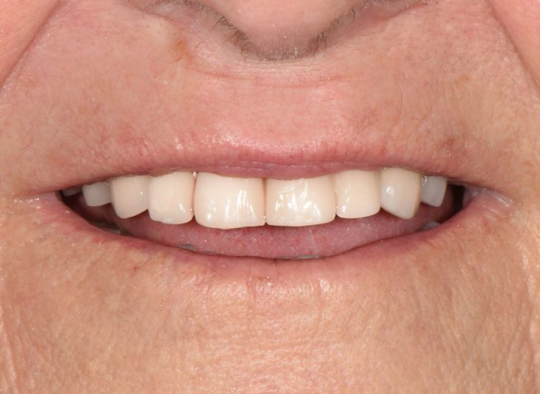 Casi clinici 100 RIABILITAZIONE CORONE SU DENTI NATURALI - dopo 7