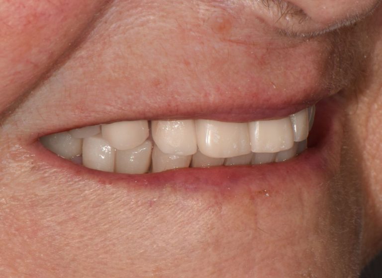 Casi clinici 102 RIABILITAZIONE CORONE SU DENTI NATURALI - dopo 8
