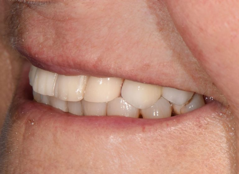 Casi clinici 98 RIABILITAZIONE CORONE SU DENTI NATURALI - dopo 9