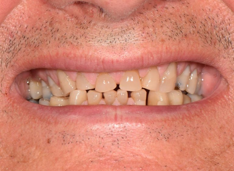 Casi clinici 87 RIABILITAZIONE CORONE SU DENTI NATURALI - prima 1