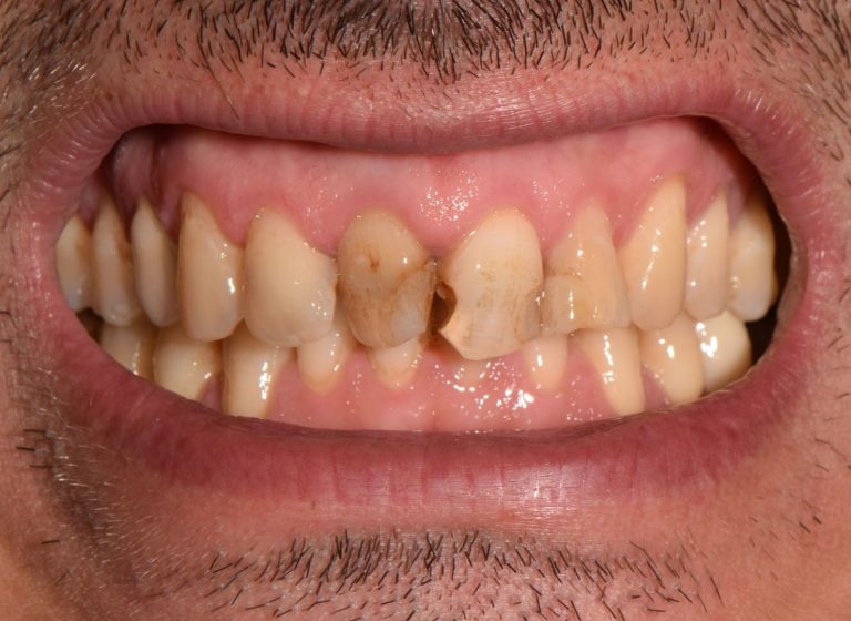 Casi clinici 105 RIABILITAZIONE CORONE SU DENTI NATURALI - prima 10