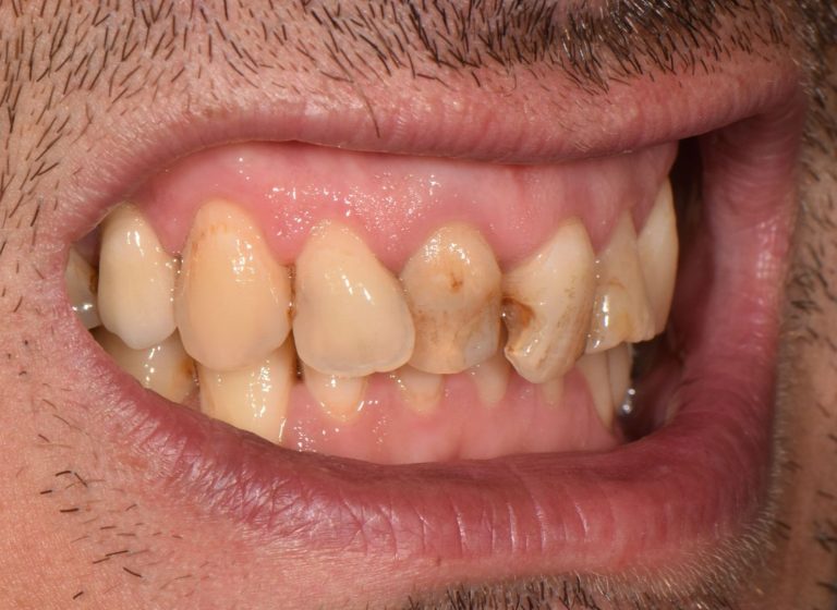 Casi clinici 107 RIABILITAZIONE CORONE SU DENTI NATURALI - prima 11