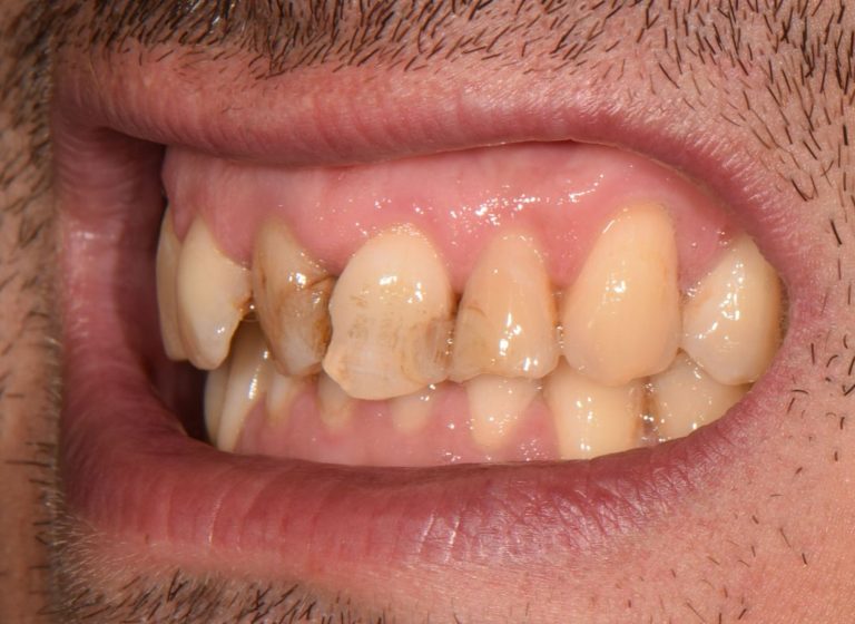 Casi clinici 103 RIABILITAZIONE CORONE SU DENTI NATURALI - prima 12