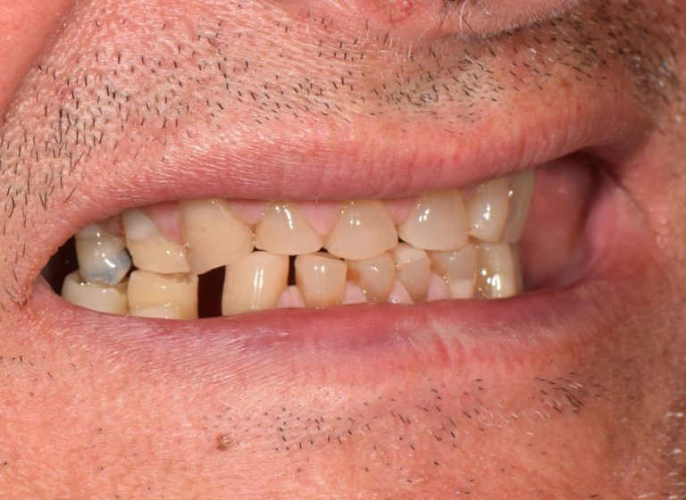 Casi clinici 89 RIABILITAZIONE CORONE SU DENTI NATURALI - prima 2