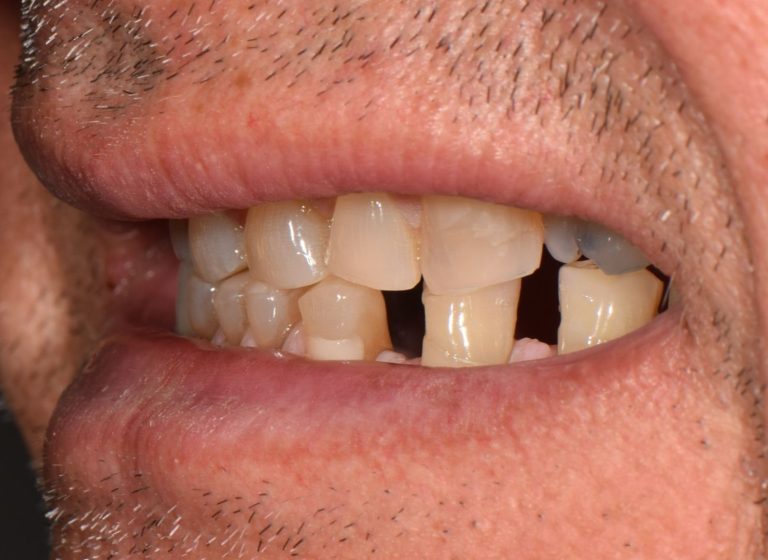 Casi clinici 85 RIABILITAZIONE CORONE SU DENTI NATURALI - prima 3