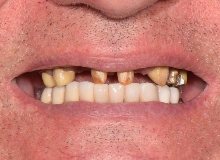 Casi clinici 93 RIABILITAZIONE CORONE SU DENTI NATURALI - prima 4