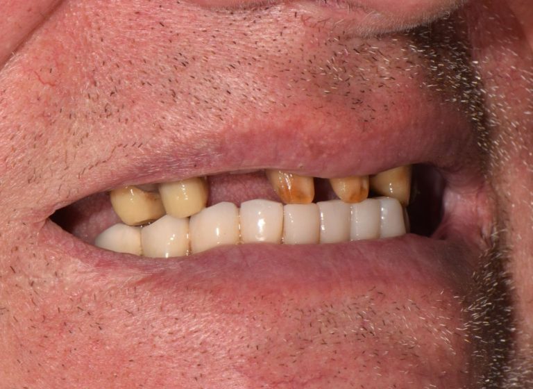 Casi clinici 95 RIABILITAZIONE CORONE SU DENTI NATURALI - prima 5