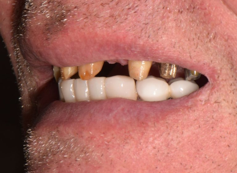 Casi clinici 91 RIABILITAZIONE CORONE SU DENTI NATURALI - prima 6