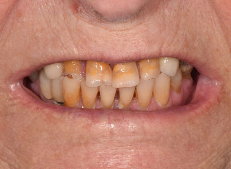 Casi clinici 99 RIABILITAZIONE CORONE SU DENTI NATURALI - prima 7