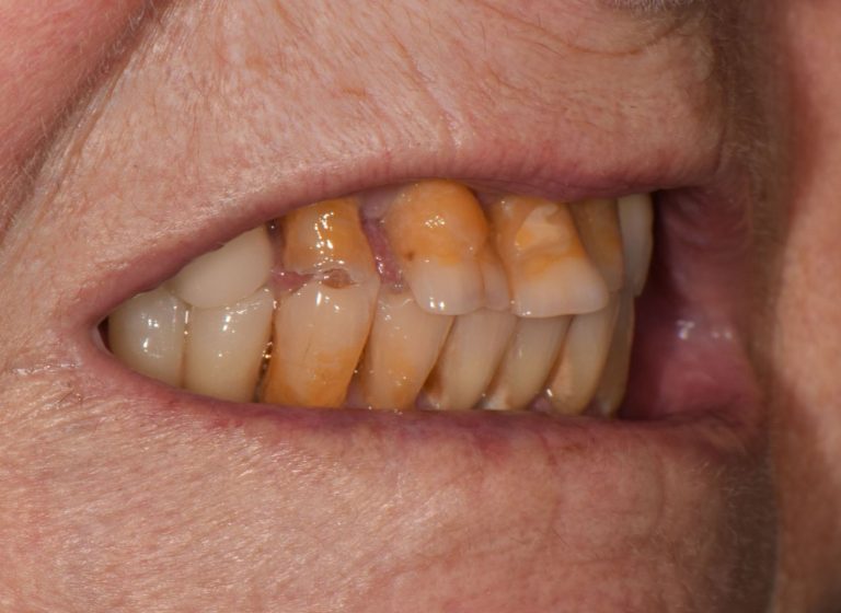 Casi clinici 101 RIABILITAZIONE CORONE SU DENTI NATURALI - prima 8