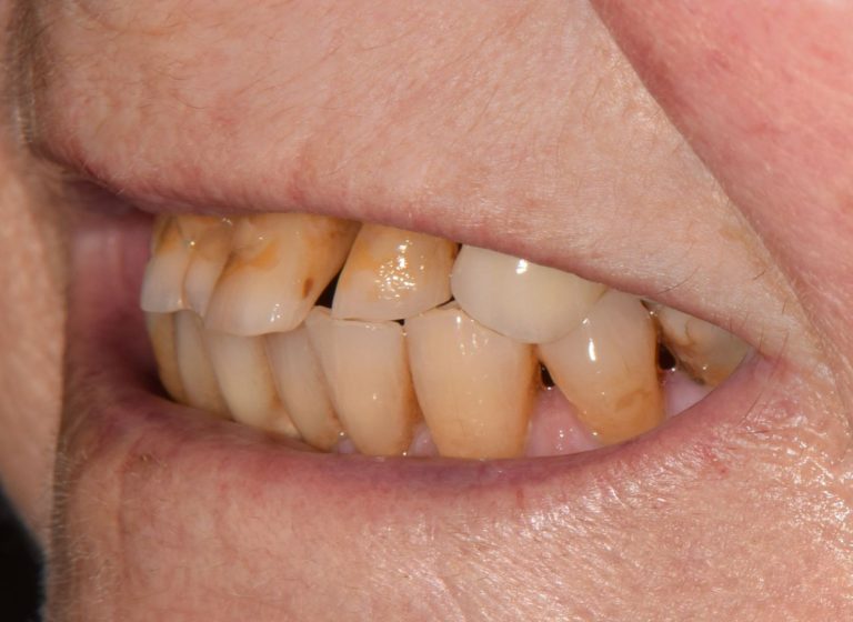 Casi clinici 97 RIABILITAZIONE CORONE SU DENTI NATURALI - prima 9