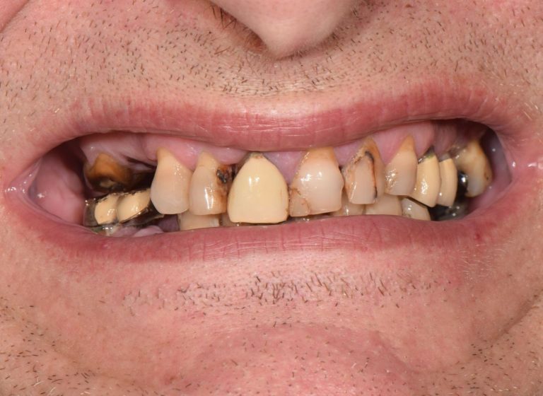Casi clinici 57 Riabilitazione implanto - protesica - prima 4