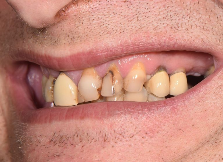 Casi clinici 55 Riabilitazione implanto - protesica - prima 5