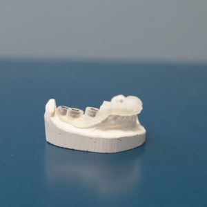 Chirurgia implantare computer guidata: scopri il trattamento! 2 Chirurgia implantare computer guidata